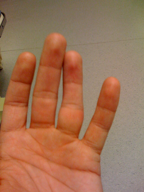 Dislocated Finger Symptoms, Causes, And Treatment 9INE POINT