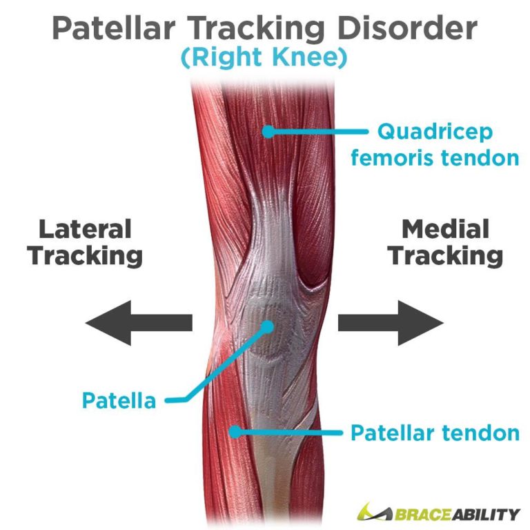 Patellar Tracking Disorder-symptoms, Causes, Treatment And Prevention 