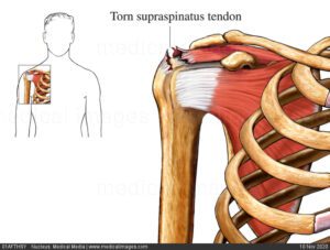 Supraspinatus Muscle Injury