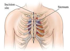 What causes a recurring bruise? I have a small bruise just below my sternum  that appears randomly, fades, and reappears. No known injuries or traumas,  it does not hurt, I don't have