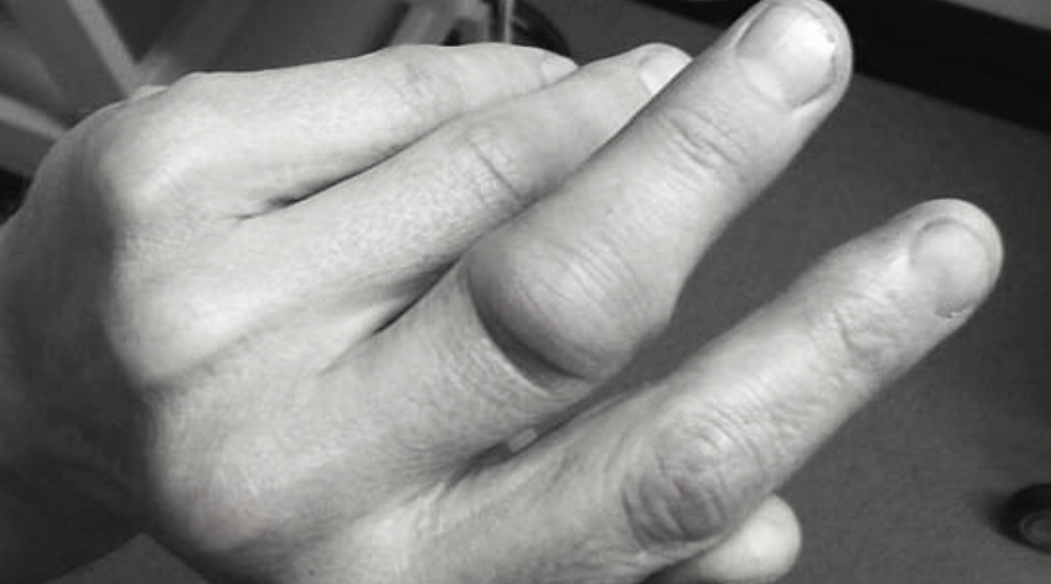 Dislocated Finger - Symptoms, Causes, And Treatment