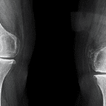 Tibial Plateau Fracture | Anatomy , Cause and Treatment