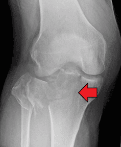 tibial plateau fracture